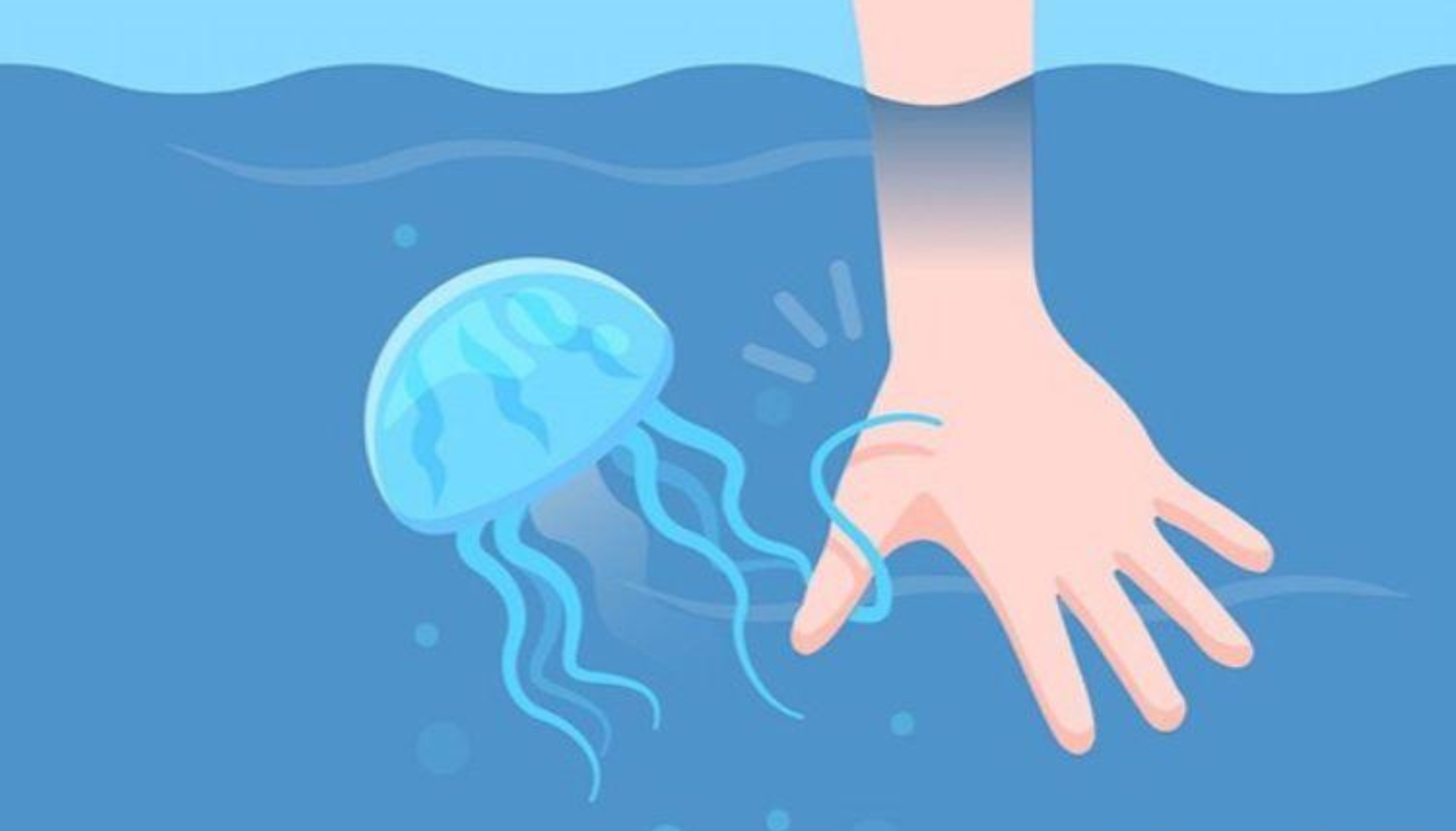 Một số triệu chứng nguy hiểm khi sứa biển cắn